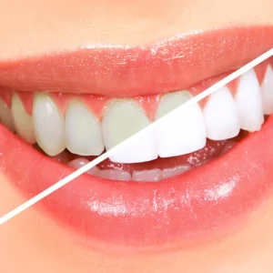 At-Home Whitening Solutions Offering Dentist-Level Results Without Office Visits Or Procedures